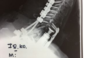 Περίπτωση : Κ.Ι. Κακοήθης Νεοπλασία Αυχενικής Μοίρας Σπονδυλικής Στήλης