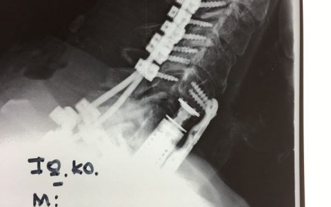 Περίπτωση : Κ.Ι. Κακοήθης Νεοπλασία Αυχενικής Μοίρας Σπονδυλικής Στήλης