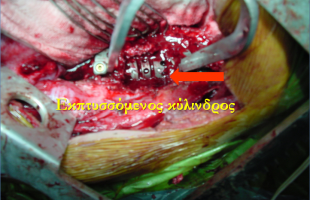 Περίπτωση Νι-Μπ: Κακοήθης Νεοπλασματική Εξεργασία 10ου Θωρακικού Σπονδύλου