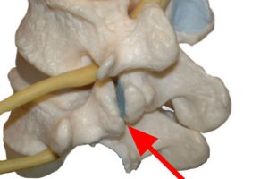 Dramatic Improvement In C2 C3 Facet Joint with Stem Cells