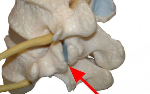 Dramatic Improvement In C2 C3 Facet Joint with Stem Cells