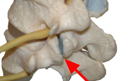 Dramatic Improvement In C2 C3 Facet Joint with Stem Cells