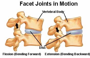 Facet Joint Syndrome