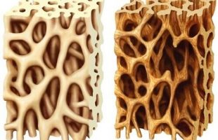 Osteoporosis causes bones to become weak and brittle