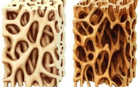 Osteoporosis causes bones to become weak and brittle