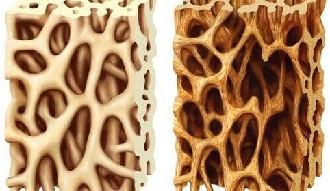 Osteoporosis causes bones to become weak and brittle