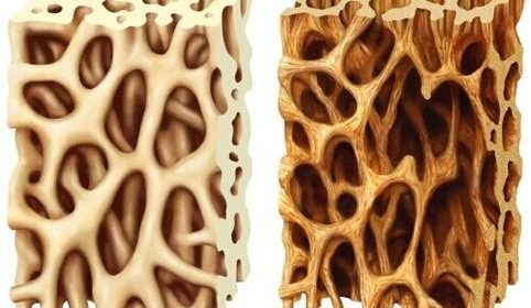 Osteoporosis causes bones to become weak and brittle