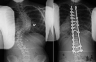 Scoliosis Surgery