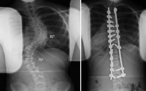 Scoliosis Surgery