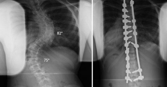 Scoliosis Surgery