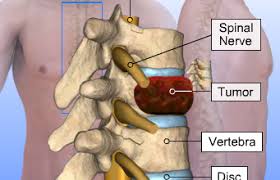 Removing Tumors from the Spine and Spinal Cord …