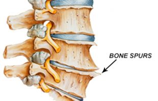 Engineered stem cells could treat degenerative disc disease