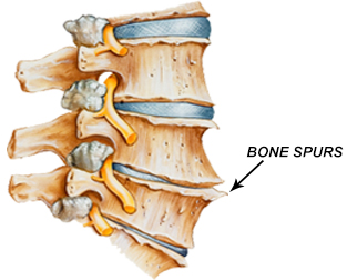 Engineered stem cells could treat degenerative disc disease