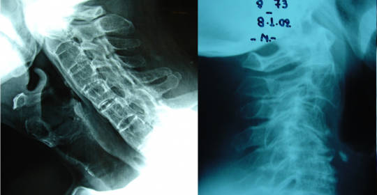 Cervical Spine Deformities 2019