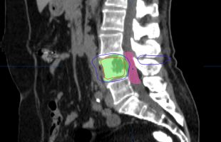 Σύγχρονες απόψεις για τη διάγνωση και αντιμετώπιση μεταστάσεων στη σπονδυλική στήλη