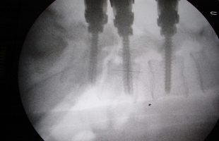 Διαδερμική Σταθεροποίηση της Σπονδυλόλυσης – Σπονδυλολίσθησης της Οσφυϊκής Μοίρας της Σπονδυλικής Στήλης (Ο.Μ.Σ.Σ.)