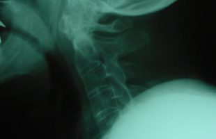 Προσθιοπισθία σταθεροποίηση κατάγματος Αυχενικής Μοίρας της Σπονδυλικής Στήλης (Α.Μ.Σ.Σ.)  επί εδάφους αγκυλοποιητικής σπονδυλίτιδας.