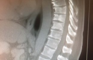 Μεταστατικό κάταγμα Θωρακικής Μοίρας της Σπονδυλικής Στήλης (Θ.Μ.Σ.Σ.) αντιμετωπισθέν δια Διαδερμικής Σπονδυλοδεσίας