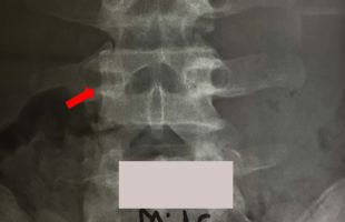 ΟΣΤΕΟΕΙΔΕΣ ΟΣΤΕΩΜΑ ΣΠΟΝΔΥΛΙΚΗΣ ΣΤΗΛΗΣ : ΧΕΙΡΟΥΡΓΙΚΗ ΑΝΤΙΜΕΤΩΠΙΣΗ