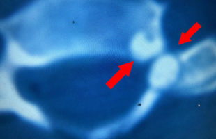 ΟΣΤΕΟΕΙΔΕΣ ΟΣΤΕΩΜΑ – ΟΣΤΕΟΒΛΑΣΤΩΜΑ ΤΟΞΟΥ – ΣΩΜΑΤΟΣ ΤΟΥ 6ου ΑΥΧΕΝΙΚΟΥ ΣΠΟΝΔΥΛΟΥ : ΟΠΙΣΘΙΑ ΚΑΙ ΠΡΟΣΘΙΑ ΧΕΙΡΟΥΡΓΙΚΗ ΑΝΤΙΜΕΤΩΠΙΣΗ