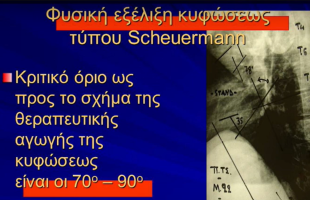 Κύφωση SCHEUERMANN – Παρουσίαση