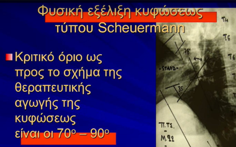 Κύφωση SCHEUERMANN – Παρουσίαση